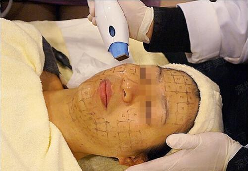 電波拉皮治療怎么樣才有效？